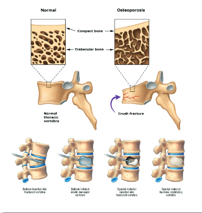 compression fracture